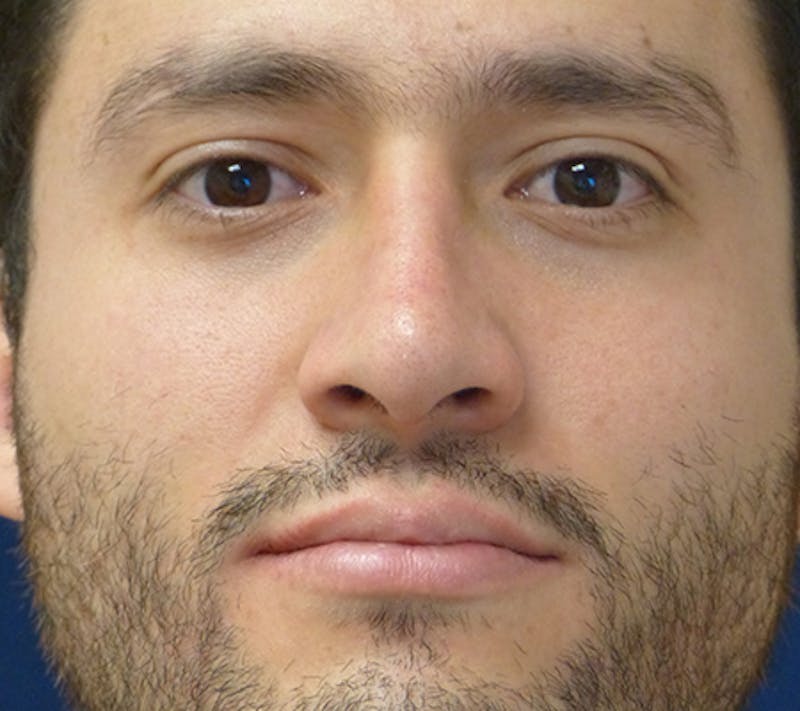 Rhinoplasty Before & After Gallery - Patient 390179 - Image 2