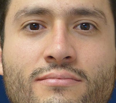 Rhinoplasty Before & After Gallery - Patient 390179 - Image 2
