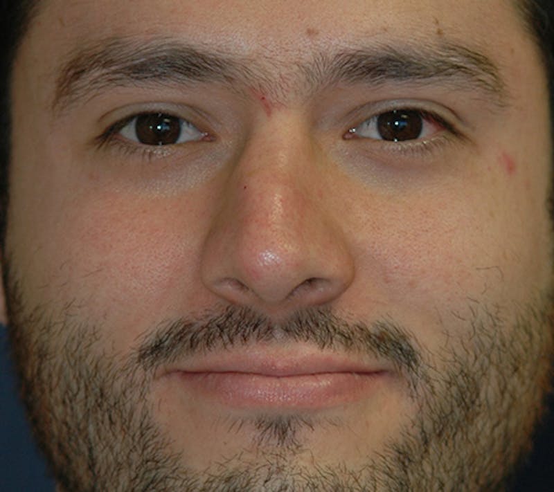 Rhinoplasty Before & After Gallery - Patient 390179 - Image 1