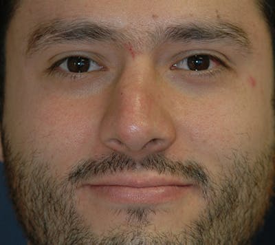 Rhinoplasty Before & After Gallery - Patient 390179 - Image 1