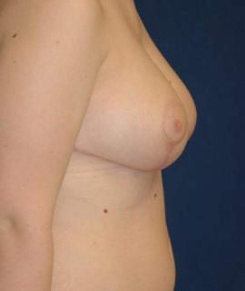 Breast Reduction Before & After Gallery - Patient 301536 - Image 4