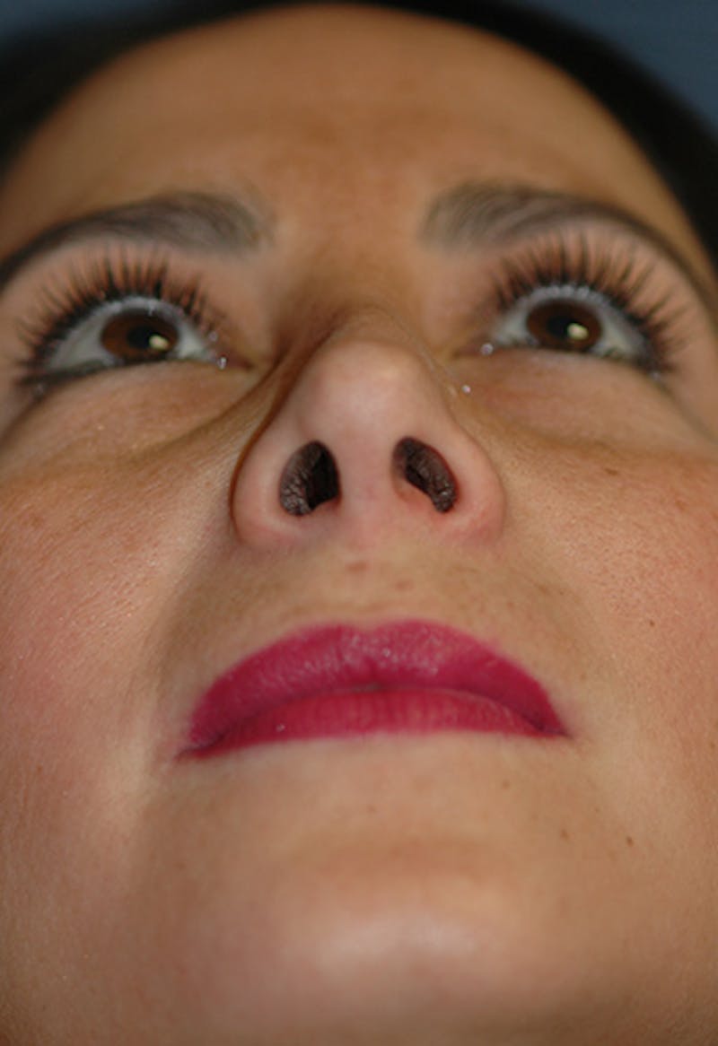 Rhinoplasty Before & After Gallery - Patient 341274 - Image 6