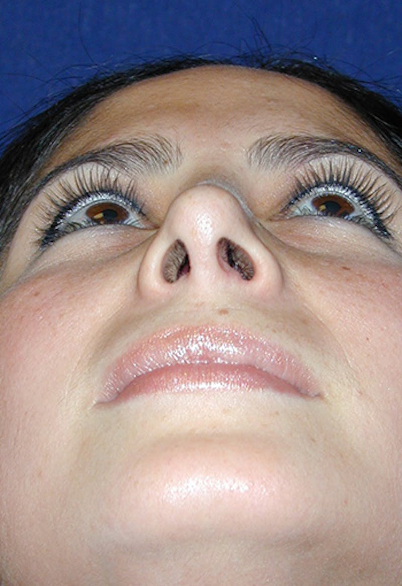 Rhinoplasty Before & After Gallery - Patient 341274 - Image 5