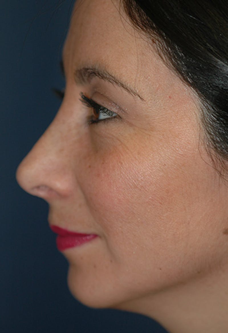 Rhinoplasty Before & After Gallery - Patient 341274 - Image 4