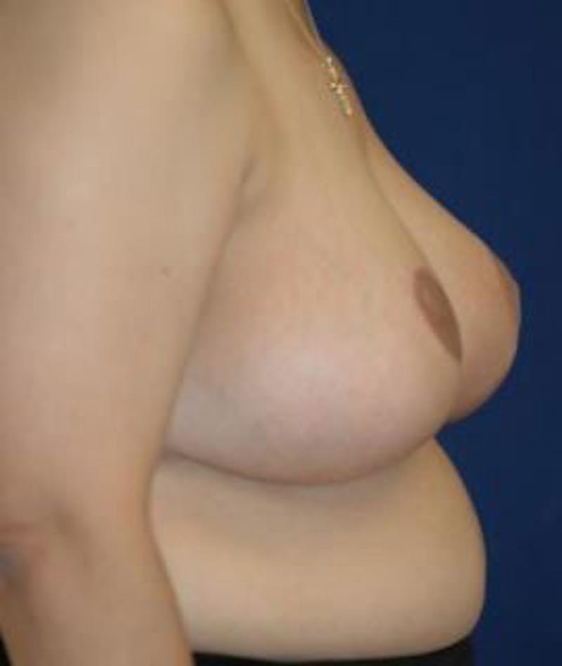 Breast Reduction Before & After Gallery - Patient 351369 - Image 4