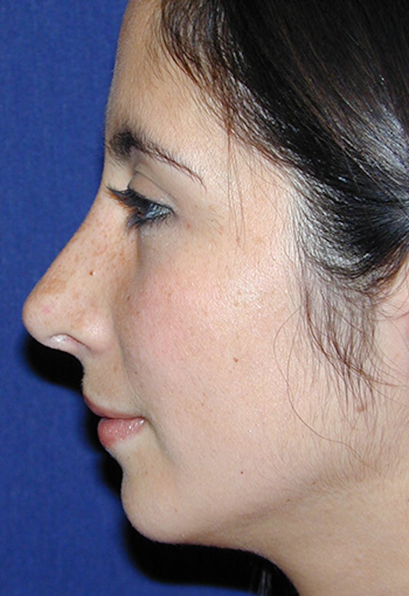 Rhinoplasty Before & After Gallery - Patient 341274 - Image 3