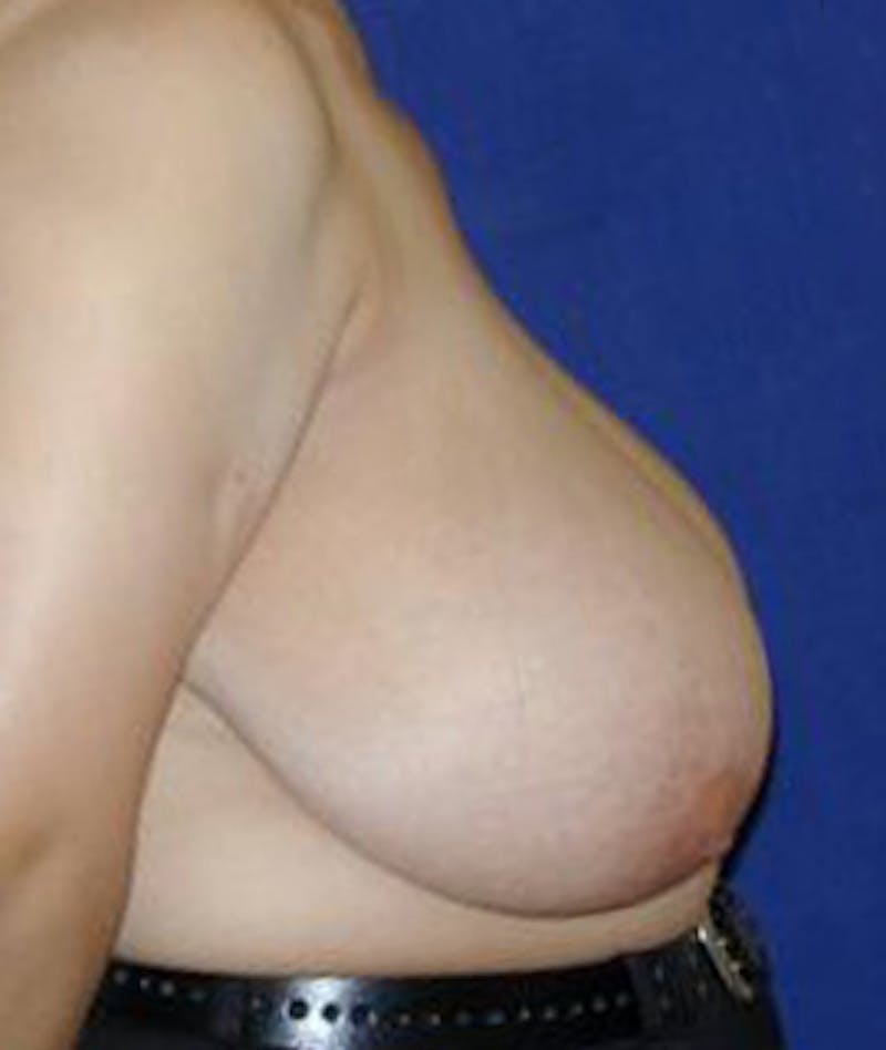 Breast Reduction Before & After Gallery - Patient 351369 - Image 3
