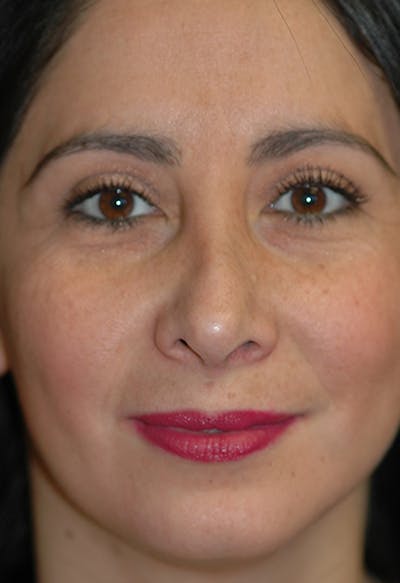 Rhinoplasty Before & After Gallery - Patient 341274 - Image 2