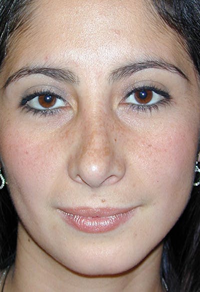 Rhinoplasty Before & After Gallery - Patient 297730 - Image 2