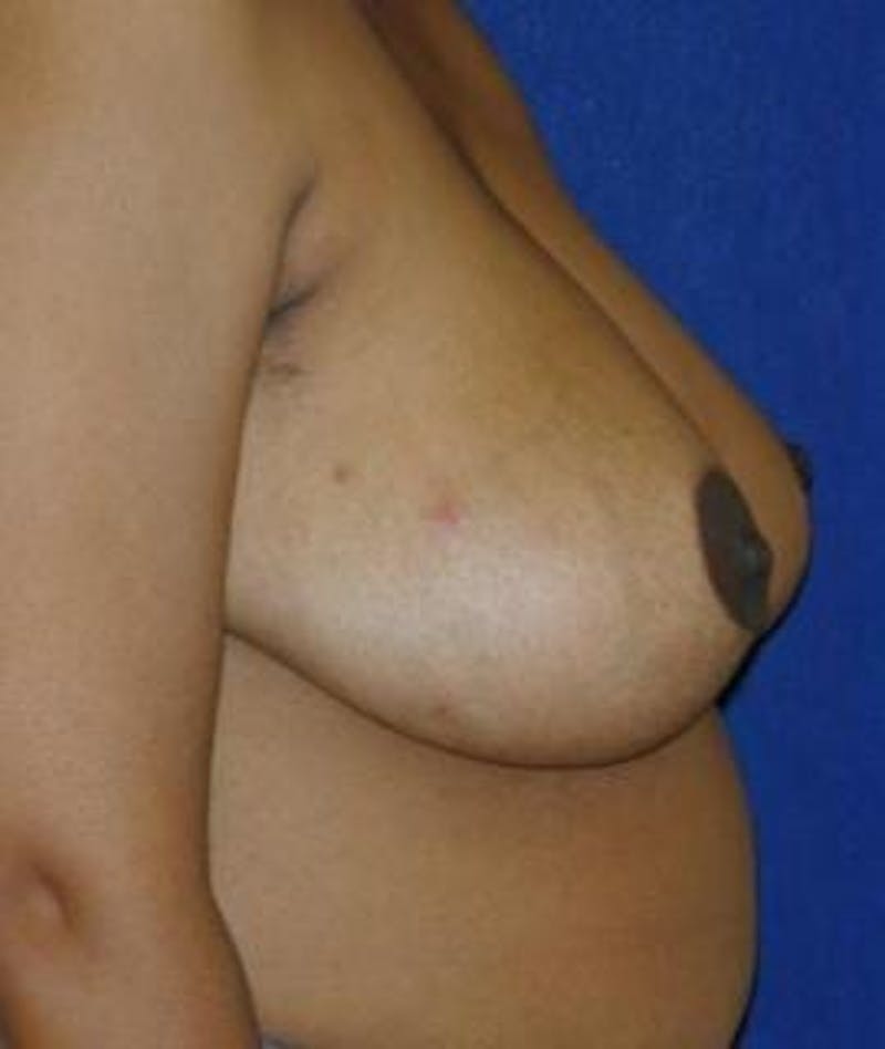 Breast Reduction Before & After Gallery - Patient 920781 - Image 4