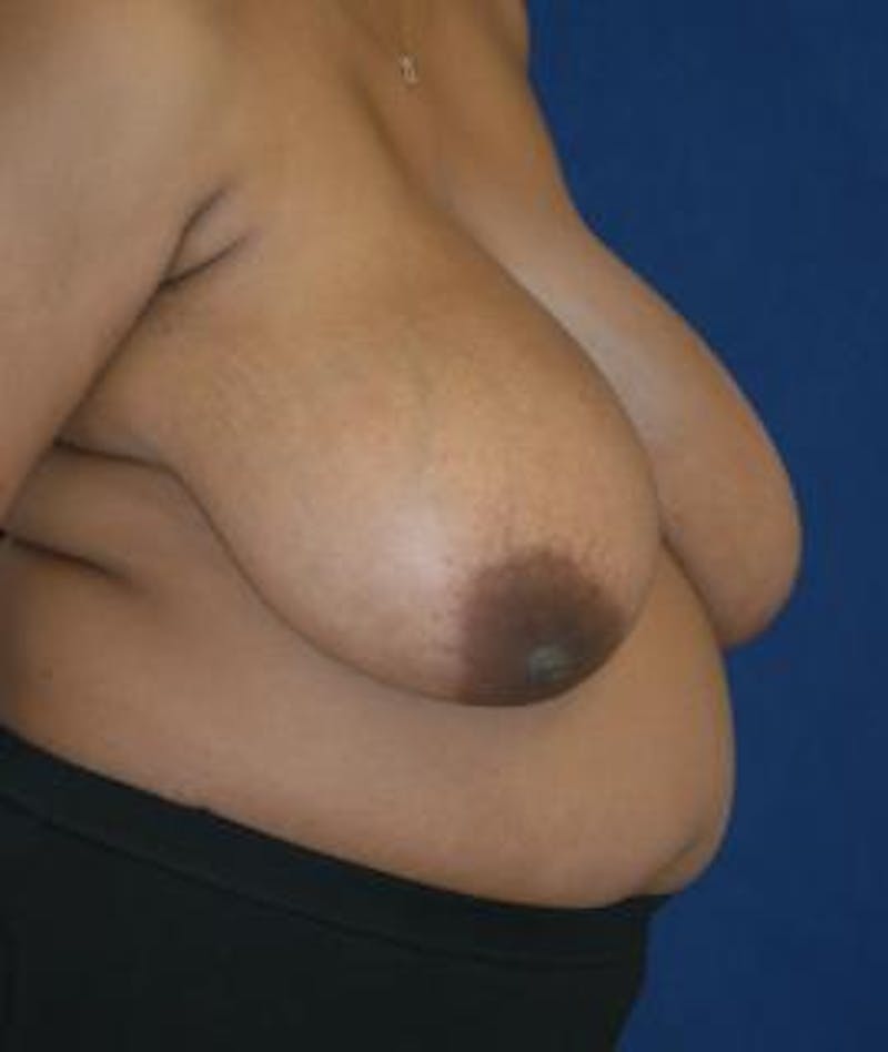 Breast Reduction Before & After Gallery - Patient 920781 - Image 3
