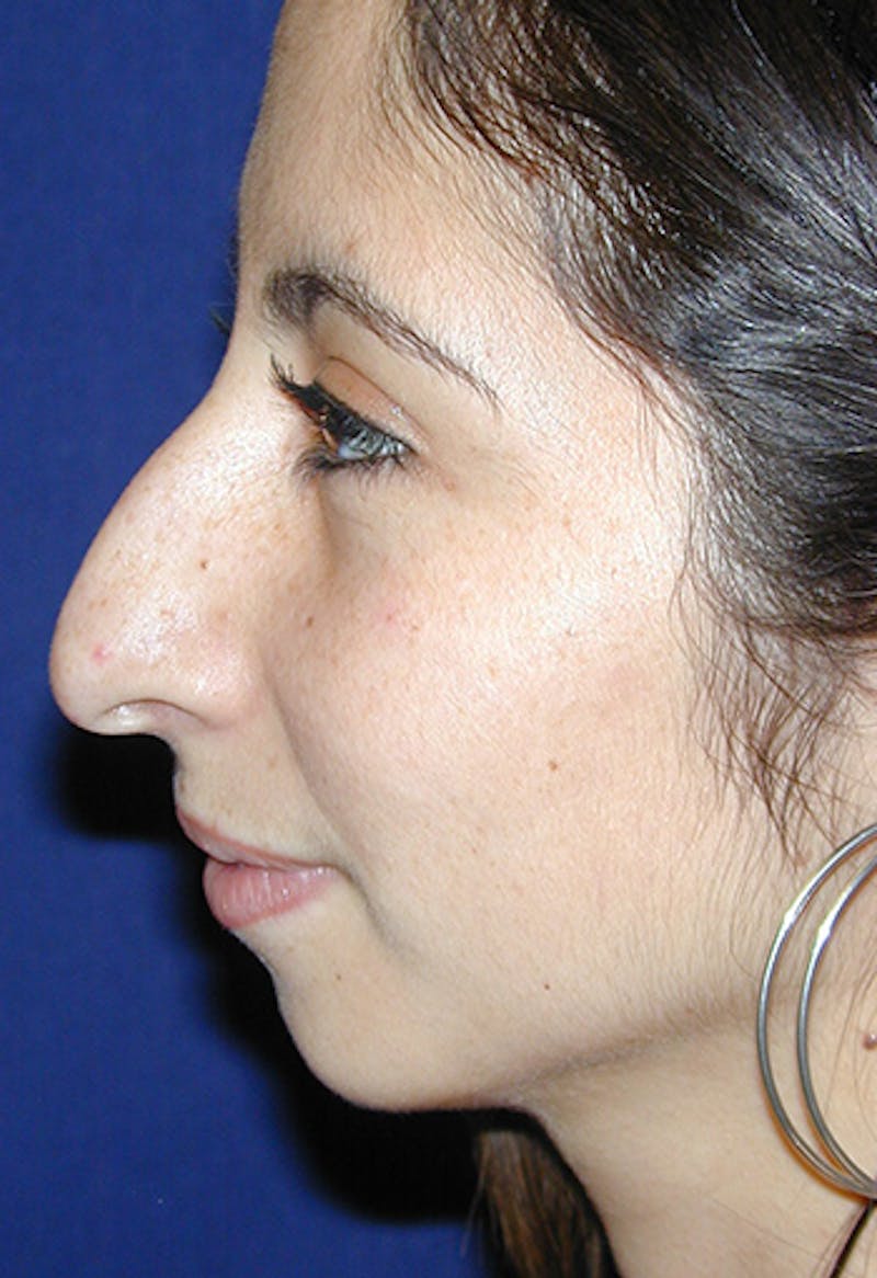 Rhinoplasty Before & After Gallery - Patient 297730 - Image 5