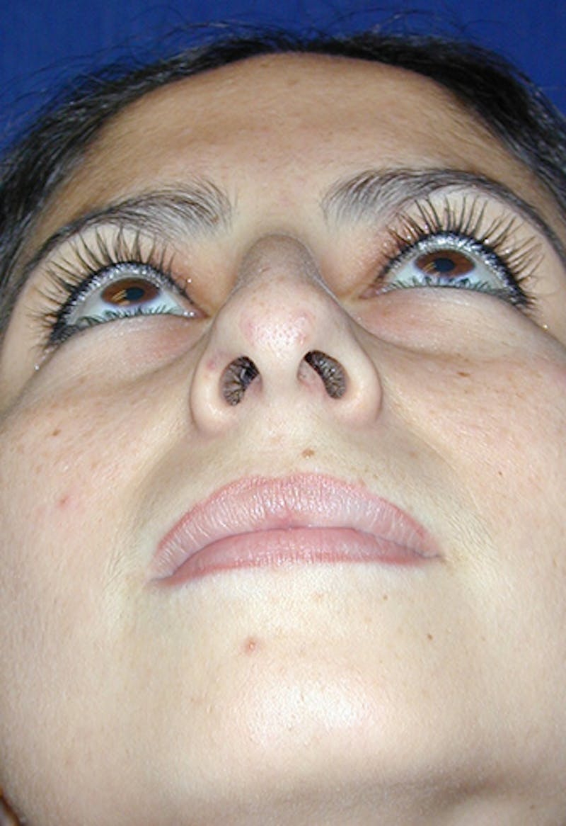 Rhinoplasty Before & After Gallery - Patient 297730 - Image 3