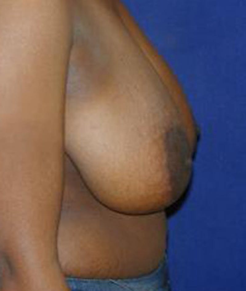 Breast Reduction Before & After Gallery - Patient 397282 - Image 3