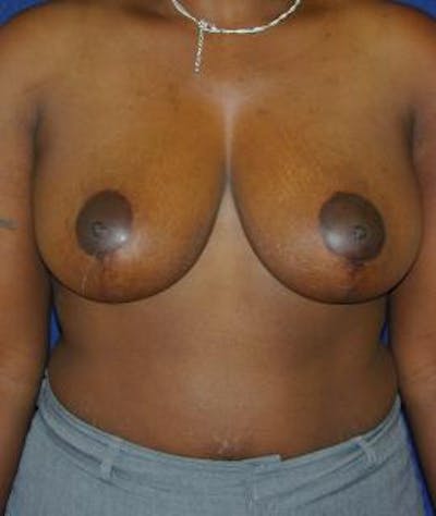 Breast Reduction Before & After Gallery - Patient 397282 - Image 2