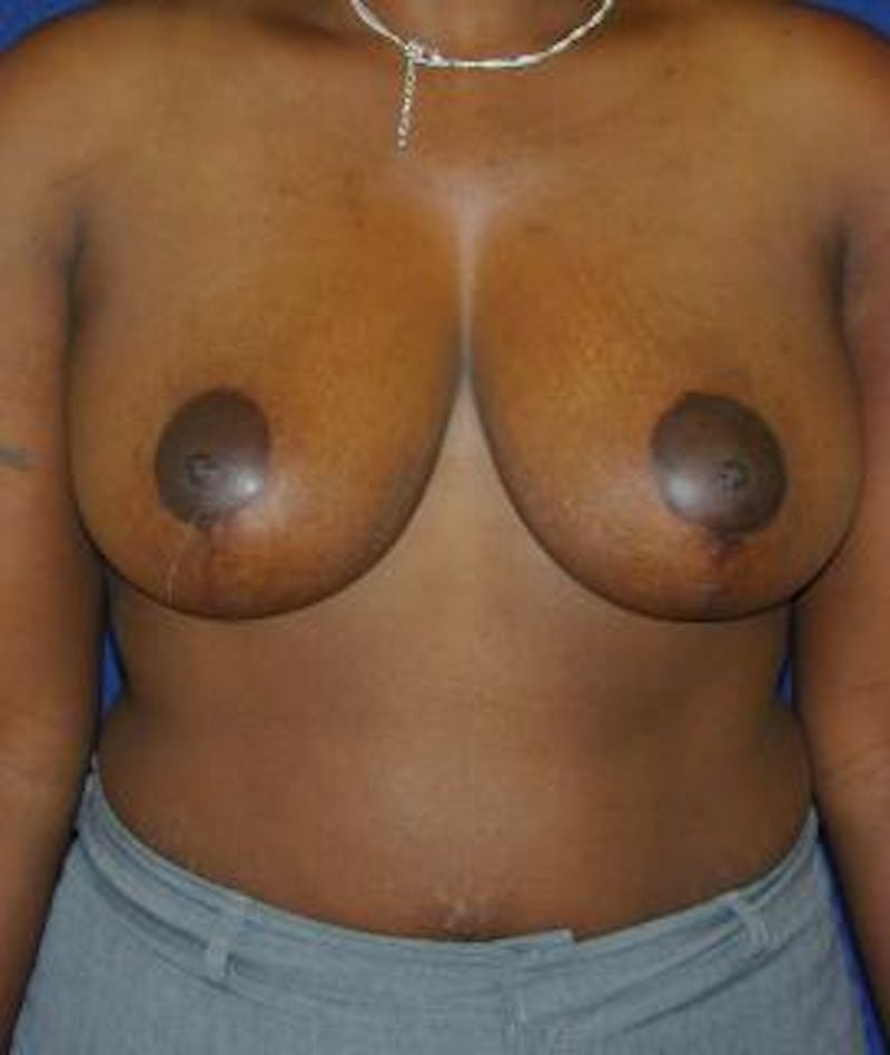 Breast Reduction Before & After Gallery - Patient 397282 - Image 2