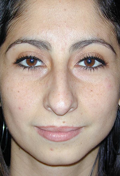 Rhinoplasty Before & After Gallery - Patient 297730 - Image 1