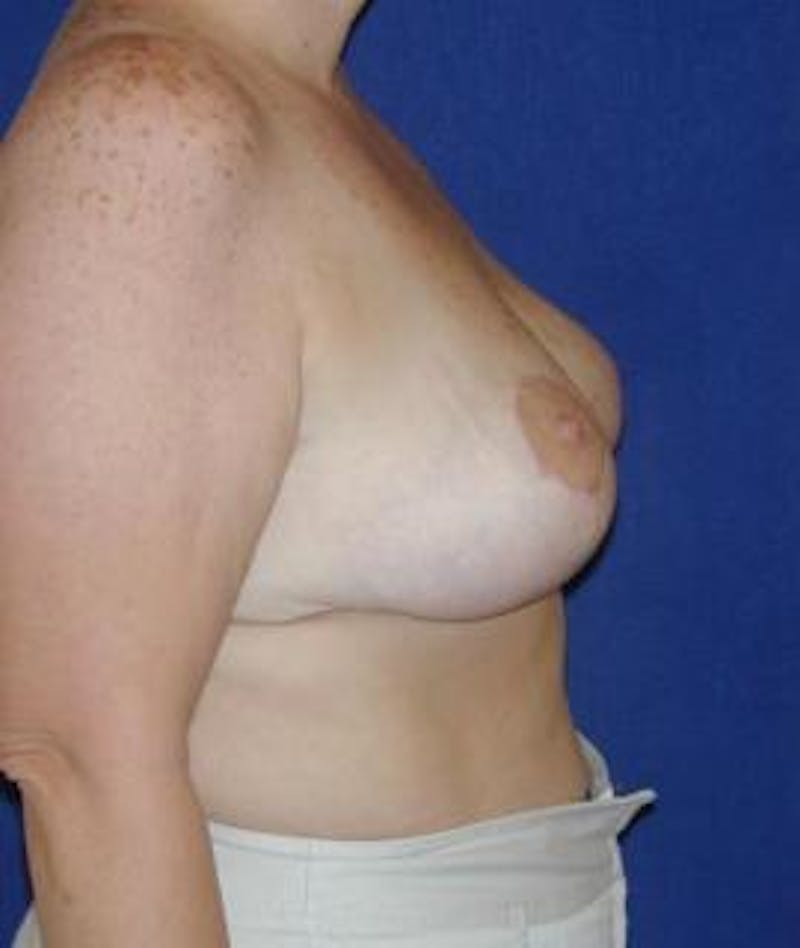 Breast Reduction Before & After Gallery - Patient 262713 - Image 4