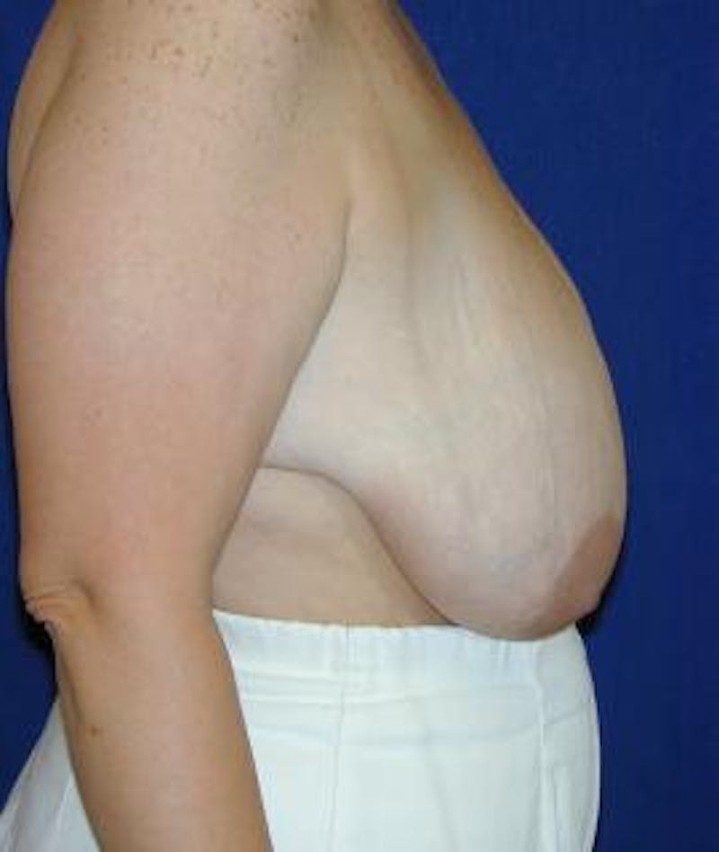 Breast Reduction Before & After Gallery - Patient 262713 - Image 3