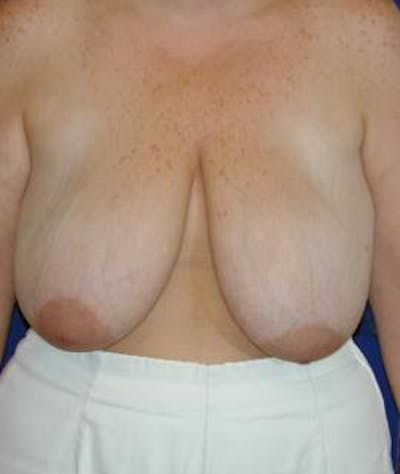 Breast Reduction Before & After Gallery - Patient 262713 - Image 1
