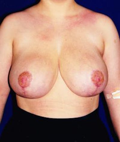 Breast Reduction Before & After Gallery - Patient 317367 - Image 2