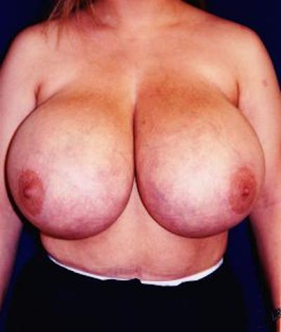 Breast Reduction Before & After Gallery - Patient 317367 - Image 1