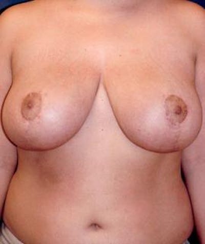 Breast Reduction Before & After Gallery - Patient 222307 - Image 2