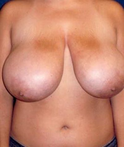 Breast Reduction Before & After Gallery - Patient 222307 - Image 1