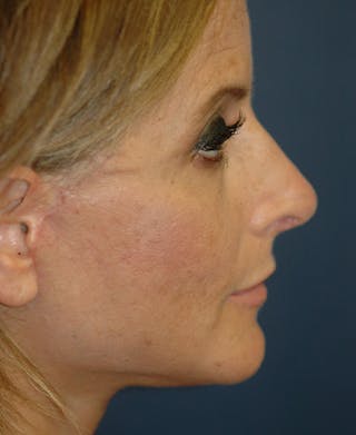 Facelift Before & After Gallery - Patient 228132 - Image 4
