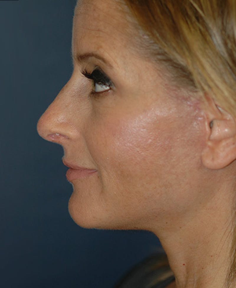 Rhinoplasty Before & After Gallery - Patient 439026 - Image 4