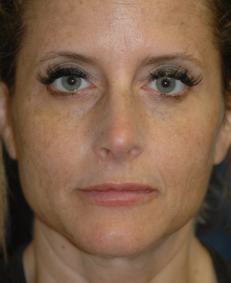 Facelift Before & After Gallery - Patient 228132 - Image 1