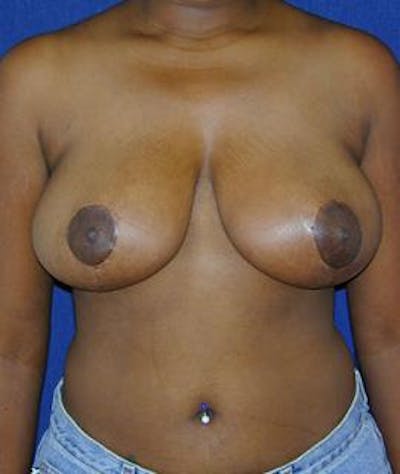 Breast Reduction Before & After Gallery - Patient 424458 - Image 2