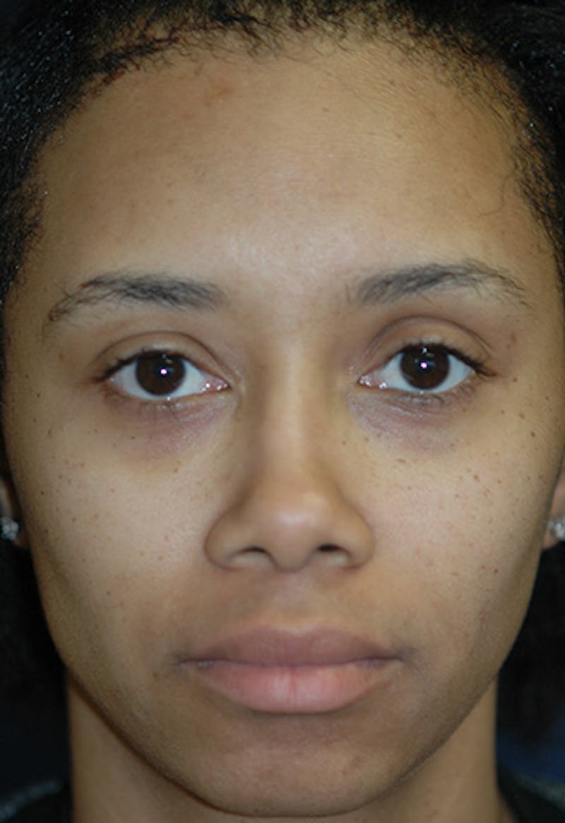 Rhinoplasty Before & After Gallery - Patient 331168 - Image 2