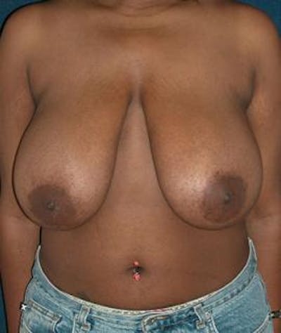 Breast Reduction Before & After Gallery - Patient 424458 - Image 1