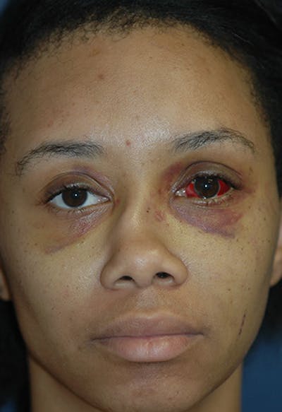 Rhinoplasty Before & After Gallery - Patient 331168 - Image 1