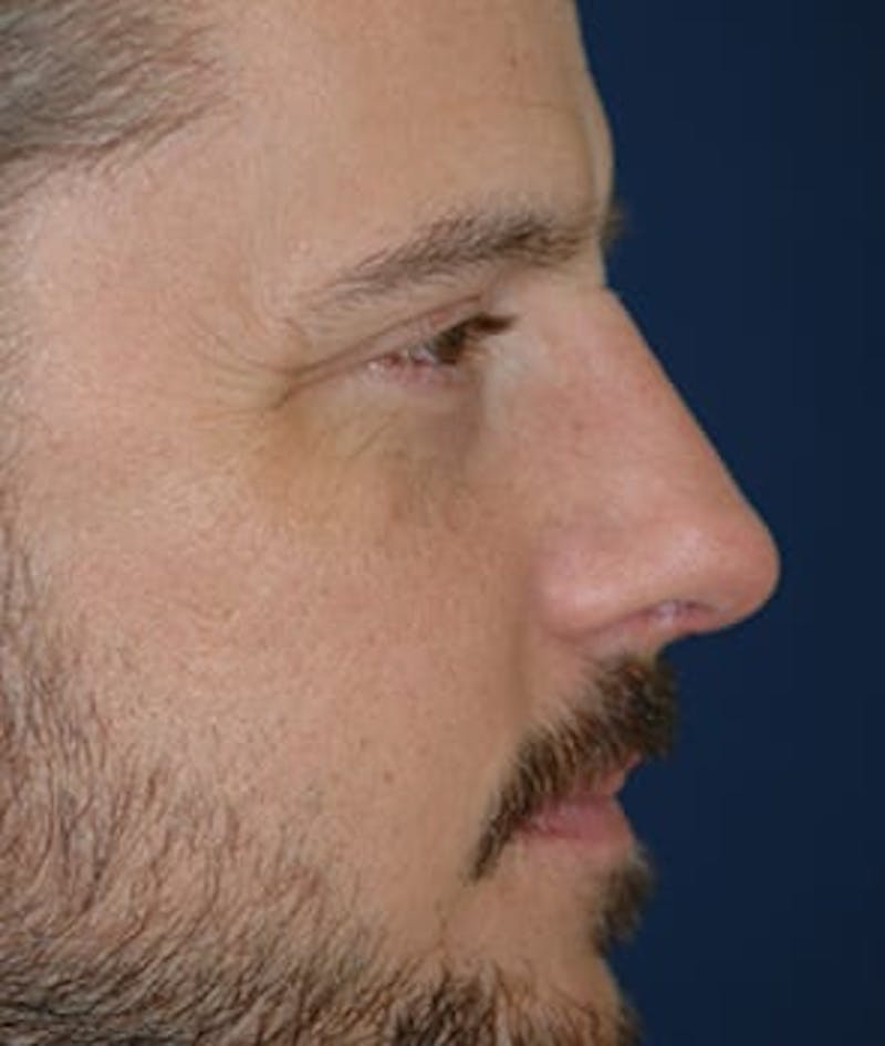 Rhinoplasty Before & After Gallery - Patient 264617 - Image 6