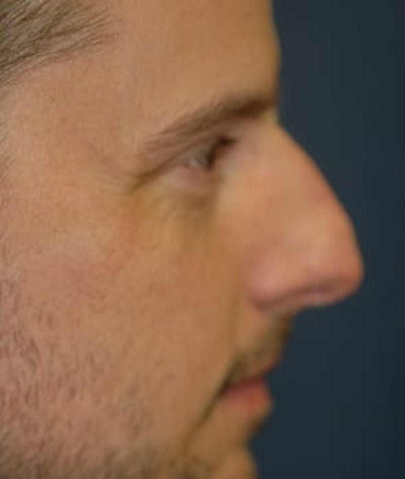 Rhinoplasty Before & After Gallery - Patient 264617 - Image 5