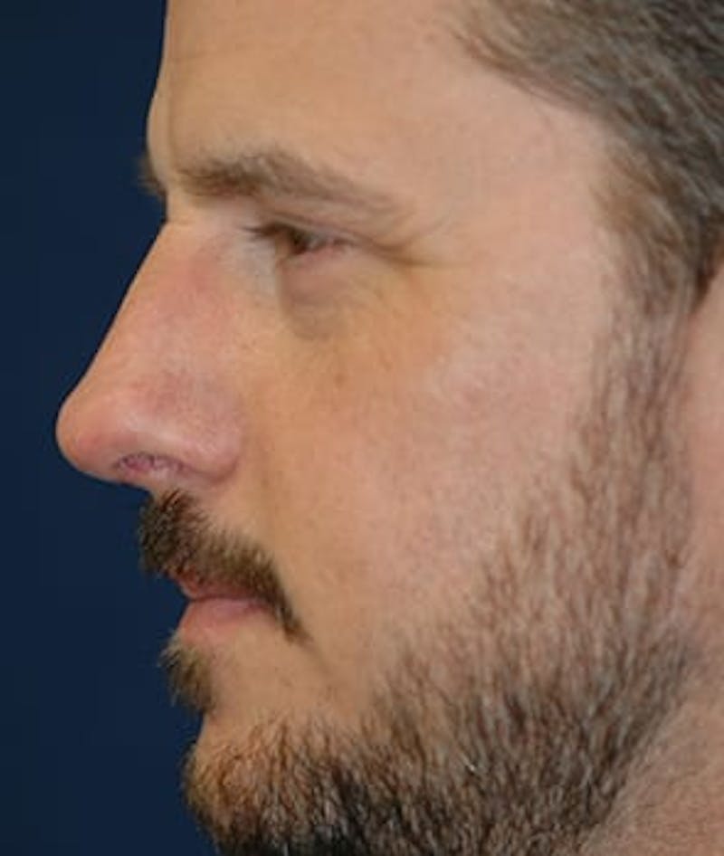 Rhinoplasty Before & After Gallery - Patient 264617 - Image 4