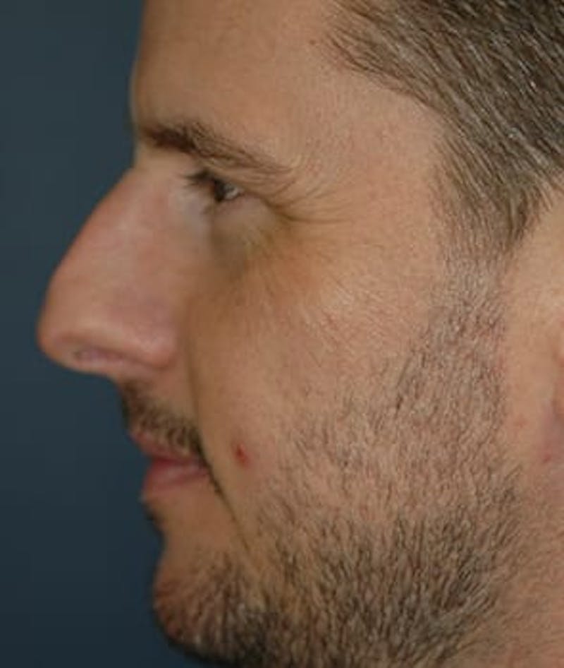 Rhinoplasty Before & After Gallery - Patient 264617 - Image 3