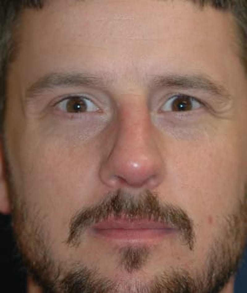 Rhinoplasty Before & After Gallery - Patient 264617 - Image 2