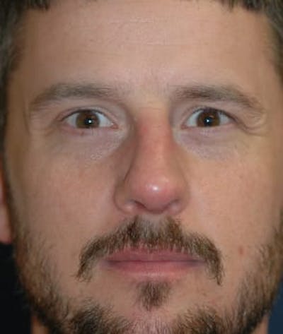 Rhinoplasty Before & After Gallery - Patient 264617 - Image 2