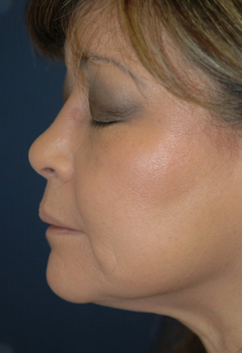 Rhinoplasty Before & After Gallery - Patient 124919 - Image 4