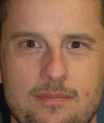 Rhinoplasty Before & After Gallery - Patient 264617 - Image 1