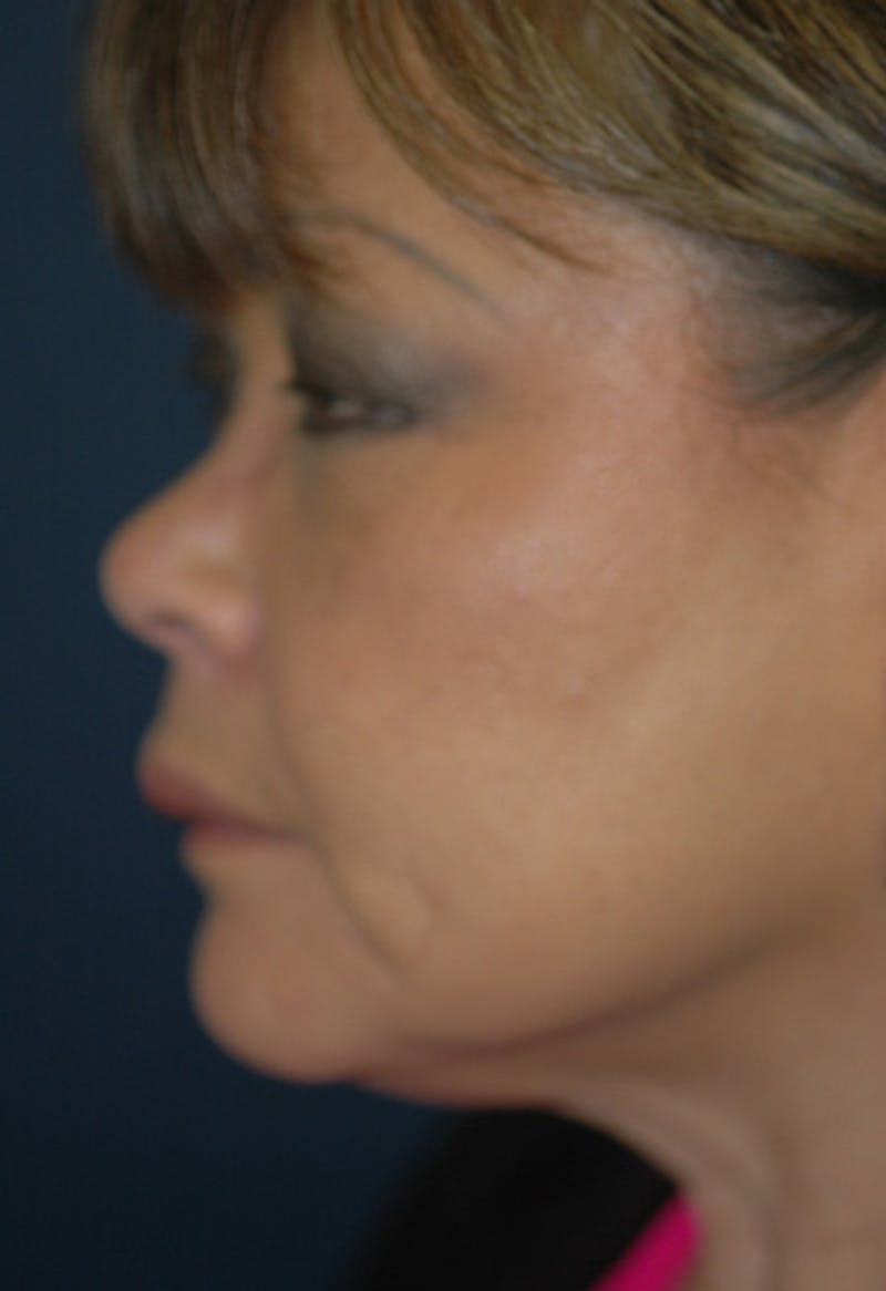 Rhinoplasty Before & After Gallery - Patient 124919 - Image 3
