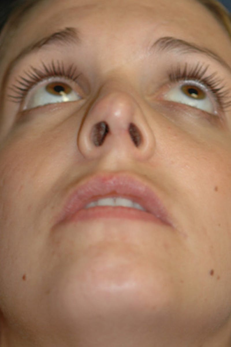 Rhinoplasty Before & After Gallery - Patient 402107 - Image 6