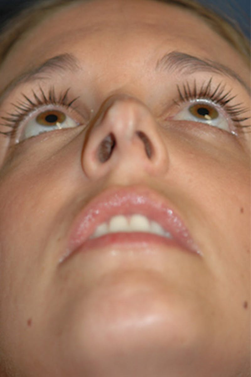 Rhinoplasty Before & After Gallery - Patient 402107 - Image 5