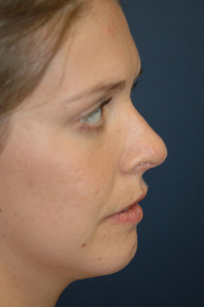 Rhinoplasty Before & After Gallery - Patient 402107 - Image 4
