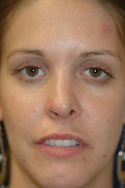 Rhinoplasty Before & After Gallery - Patient 402107 - Image 2