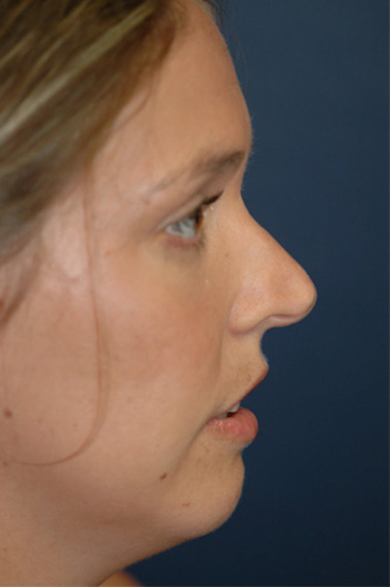 Rhinoplasty Before & After Gallery - Patient 402107 - Image 3