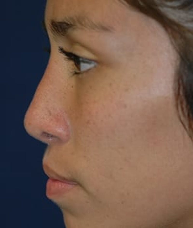 Rhinoplasty Before & After Gallery - Patient 410628 - Image 4